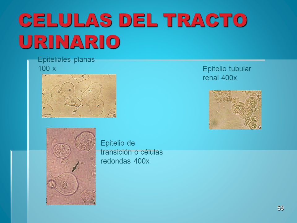 Celulas epiteliales planas altas en orina
